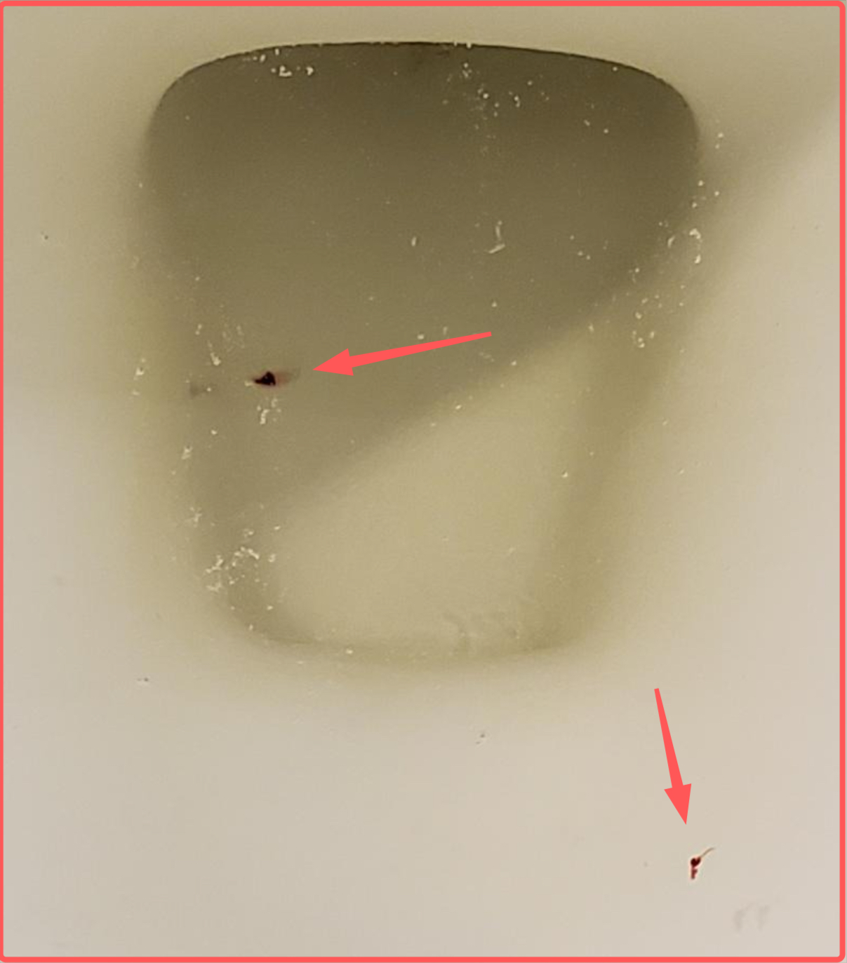 https://doctor-explains.com/wp-content/uploads/2022/11/small-tiny-blood-clot-in-urine.jpg
