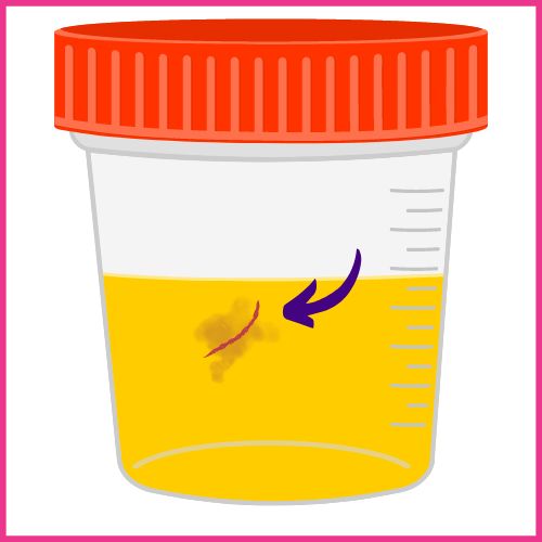 stringy or worm like blood clots in urine