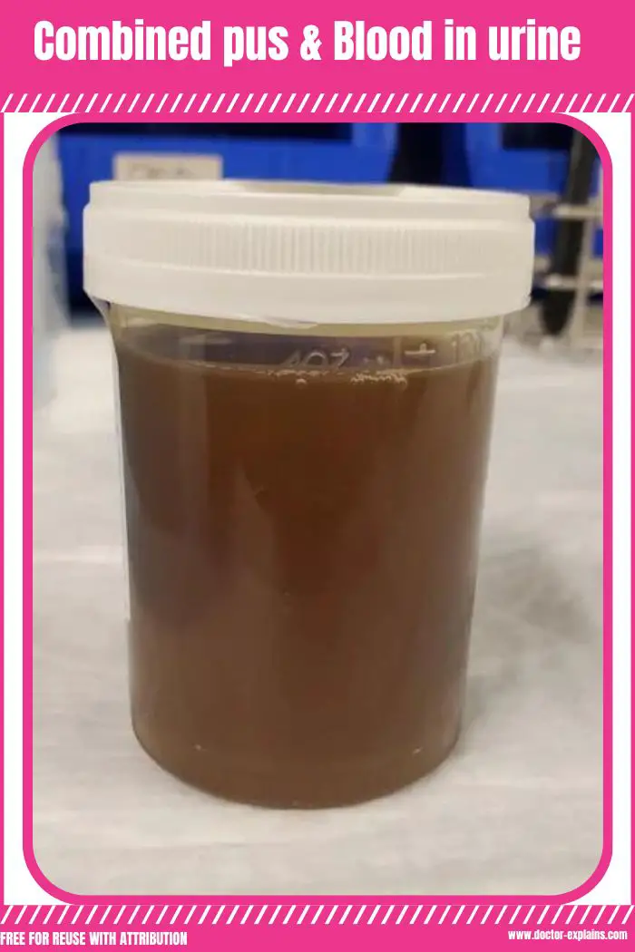 https://doctor-explains.com/wp-content/uploads/2023/03/pus-and-blood-in-urine-looks-like-brownish-opaque-fluid.jpg