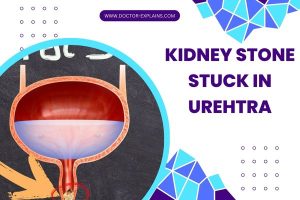 Kidney Stone Stuck in Urethra Female: Symptoms and Diagnosis